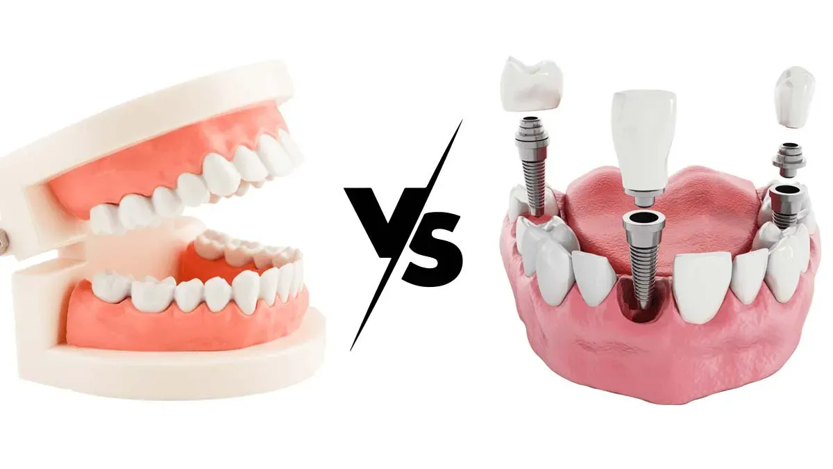 Dental Implants or Dentures